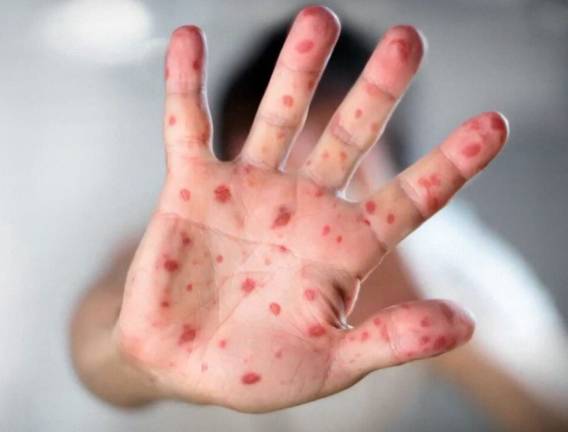 County to state: Eliminate non-medical vaccination exemptions County to state: Eliminate non-medical vaccination exemptions