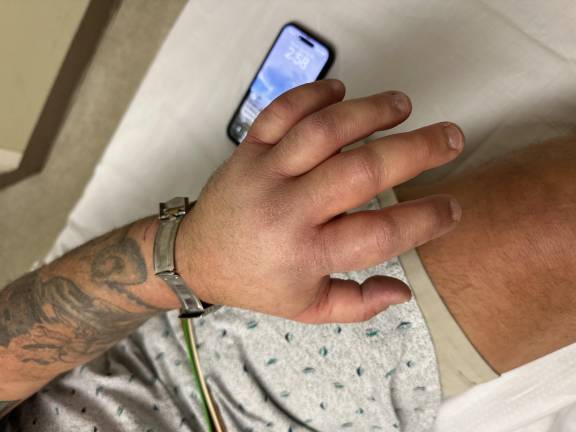 Nearly painless, occasionally fatal: What’s it like to get bitten by a rattler? Parker Space’s hand when he arrived at Newton Medical Center after a massasauga rattlesnake bite.